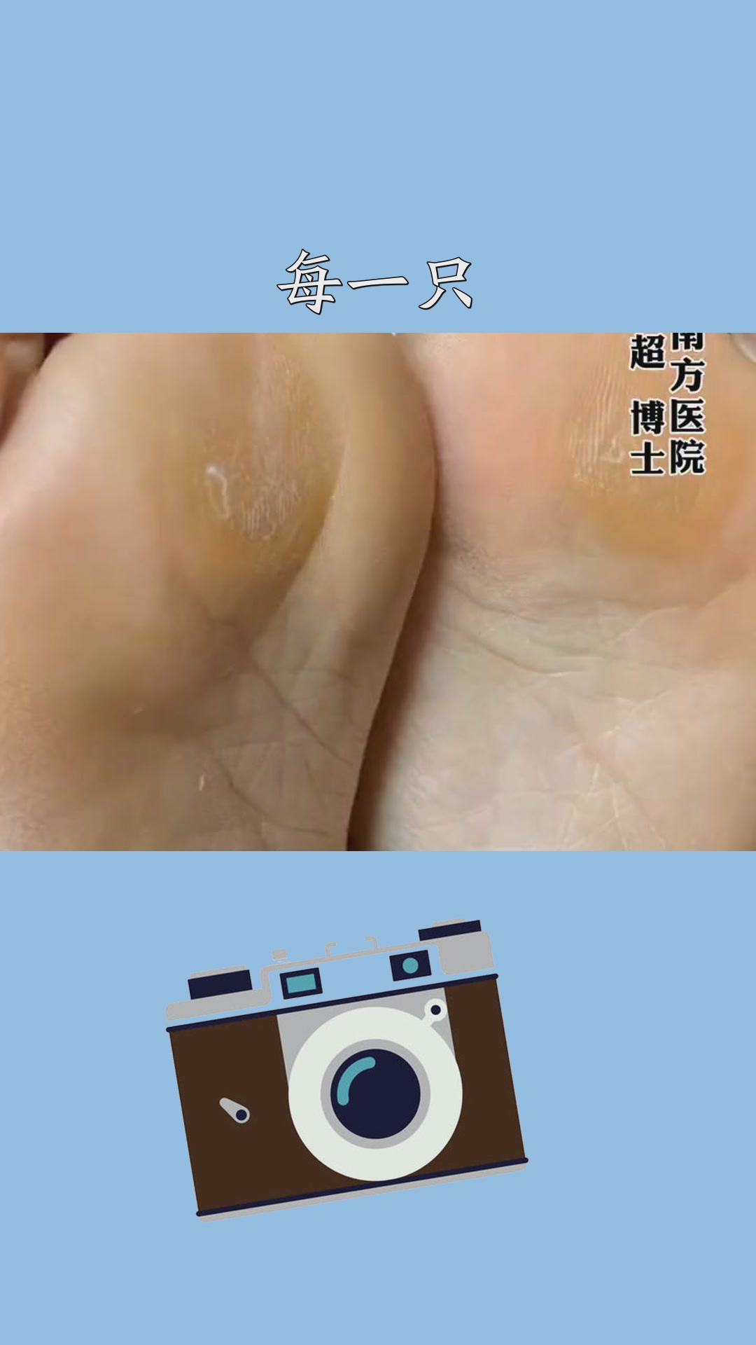 横弓塌陷脚痛高跟鞋老茧健康 #百万视友赐神评