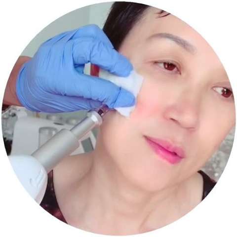 上午的三线提升,提升苹果肌,淡化法令纹淡化木偶纹,脸部轮廓整天提升