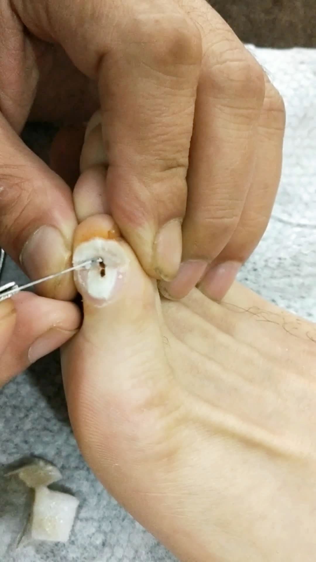 肉刺鸡眼三天ok