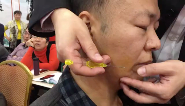 埋线地仓,耳前穴,治疗面瘫,面肌痉挛