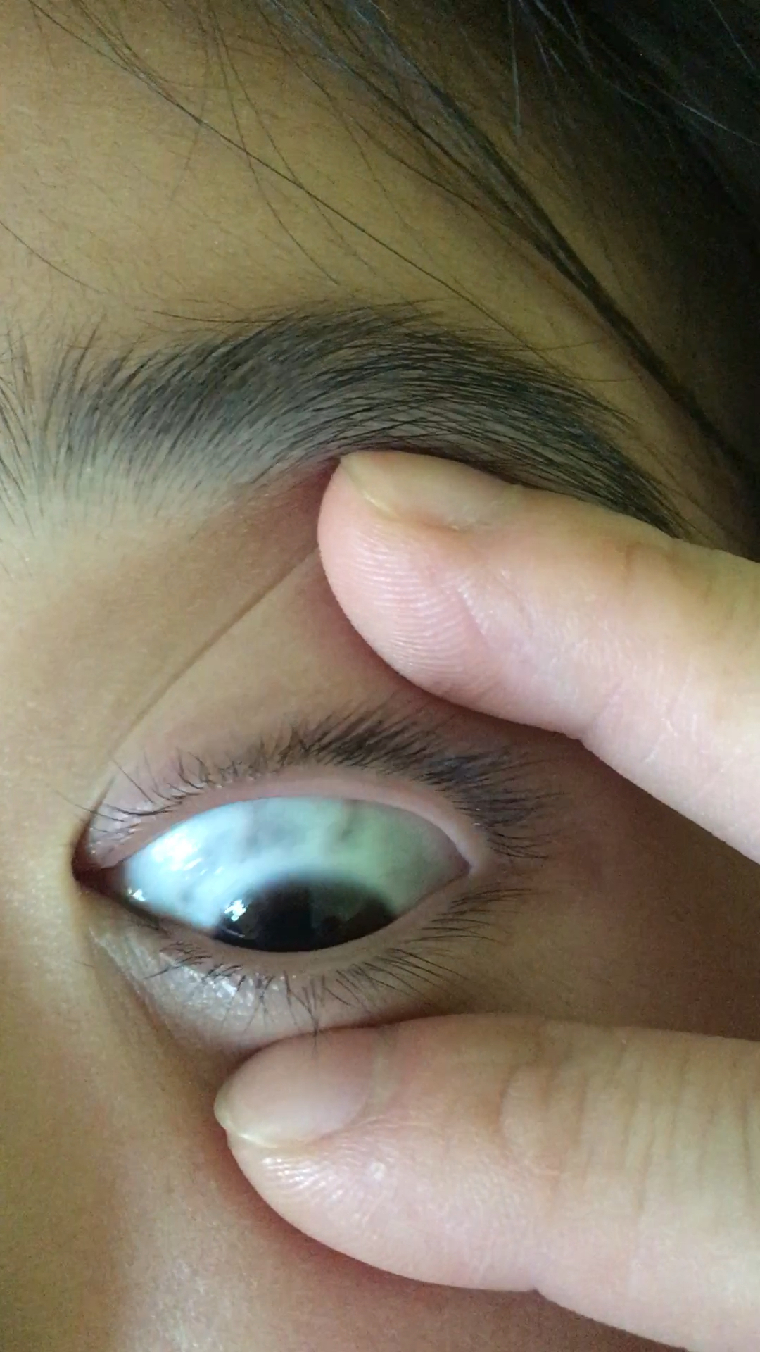 眼睛黑斑!请重视起来