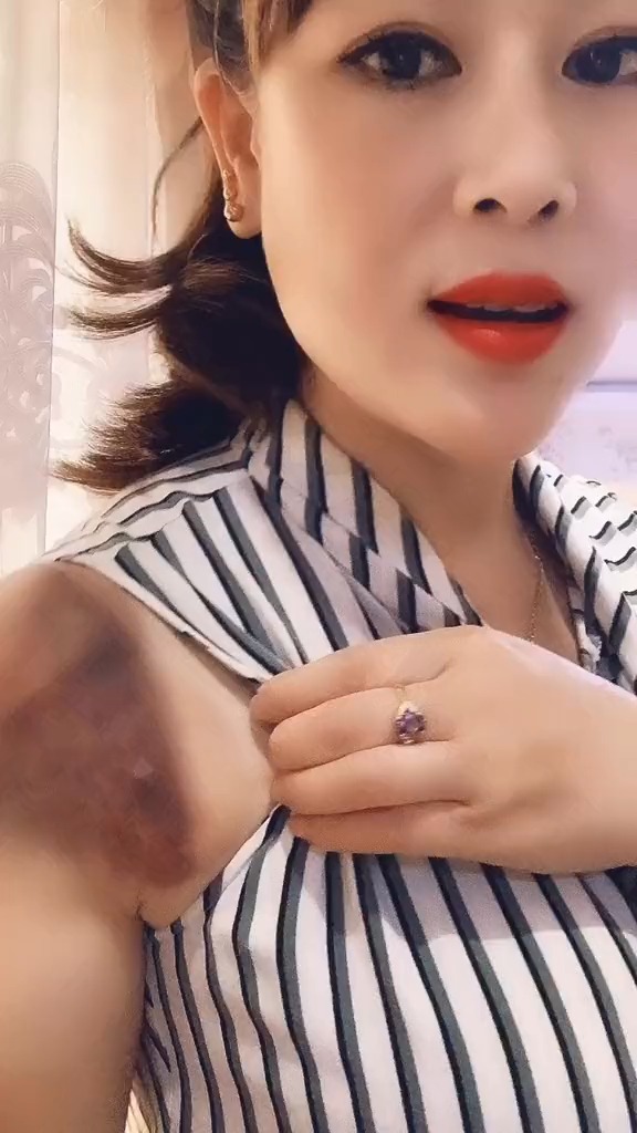 这么毒,把我咬成这样.整个肩膀又肿又黑的.