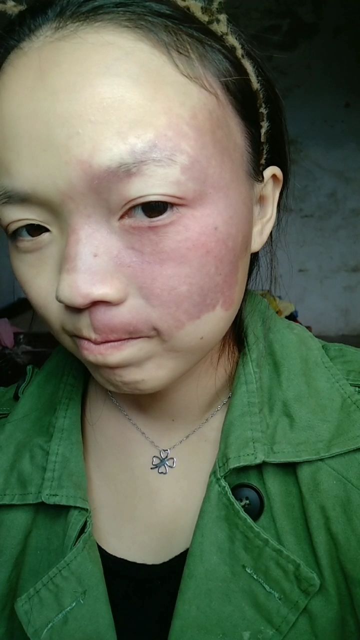 胎记女孩的故事