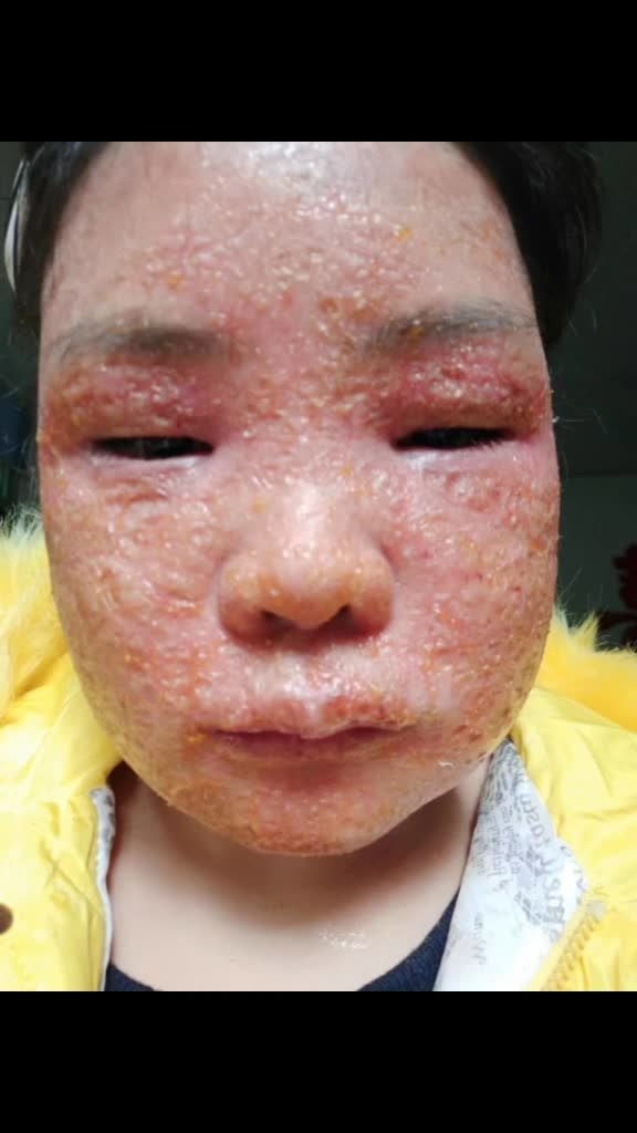 她说:这么严重的激素脸,以为就这样完蛋了.