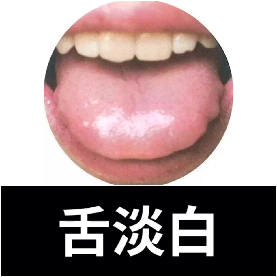 舌相分析:舌淡白93舌质嫩 治法:补益心脾,养心安神