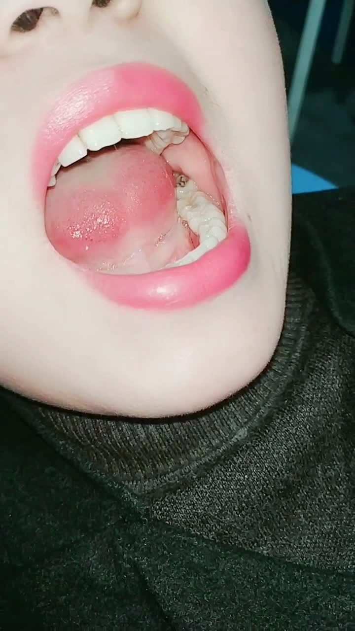 美女拔智齿!2分钟完成!