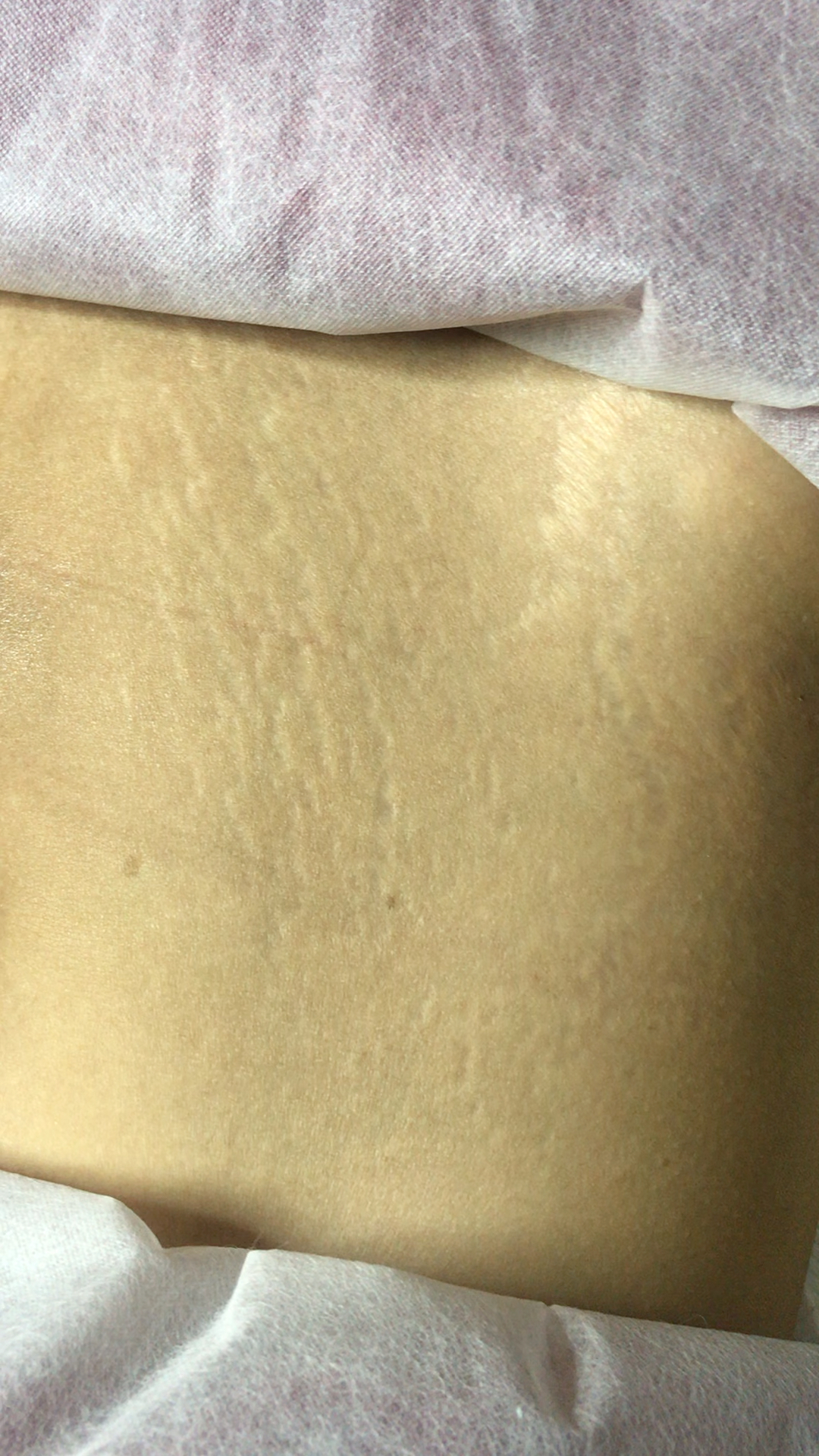 "二胎2年了,妊辰纹老公嫌弃,睡觉时一直躲着我!