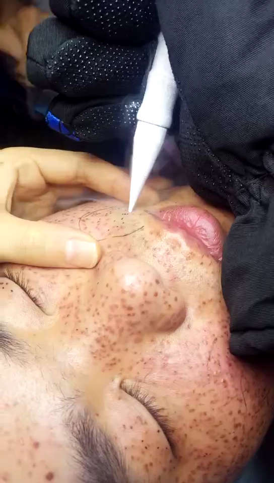 冷冻祛斑色素提取.祛斑效果缸缸的