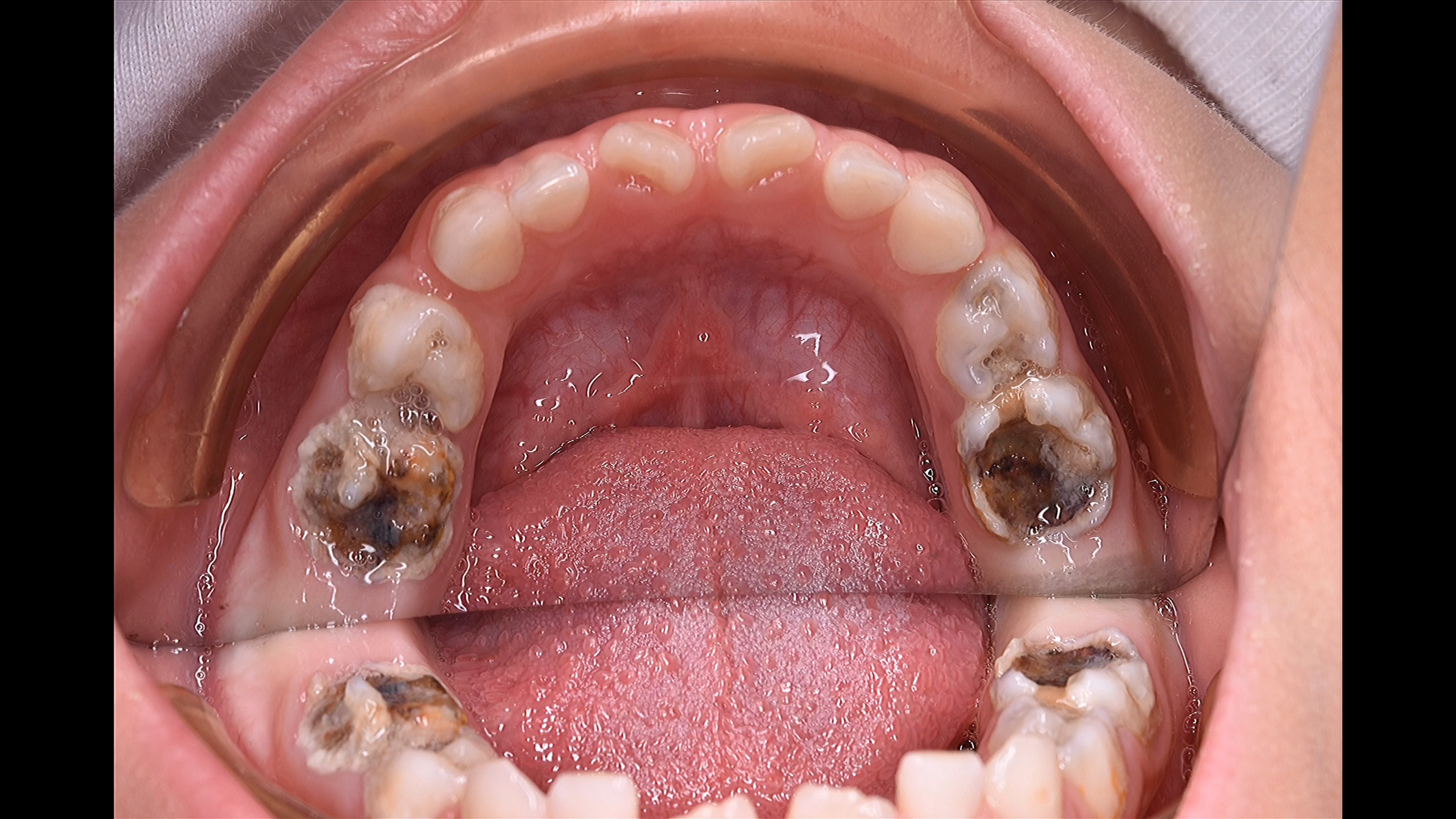 把烂牙补好也是很有成就感的.