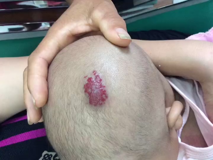 儿童头部血管瘤(许昌德医堂)595染料激光前后对比