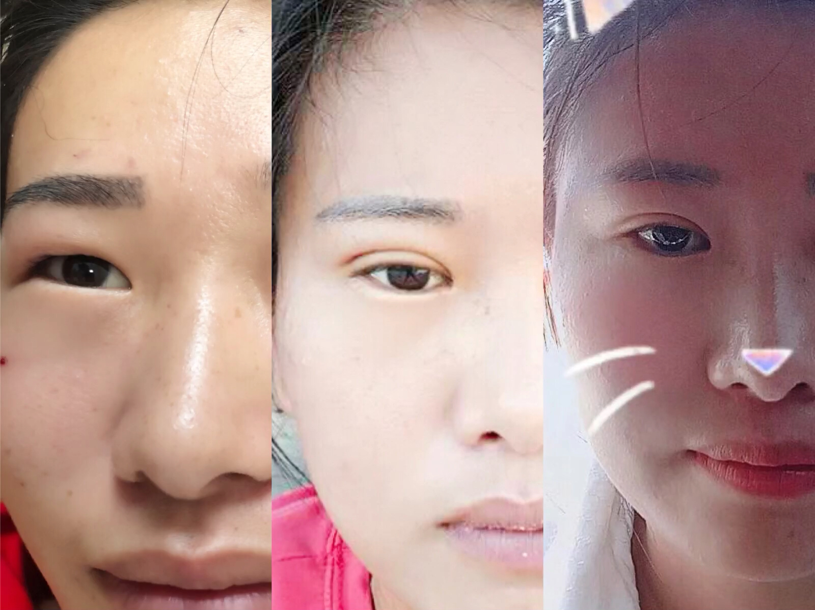 无痕抽脂77日式无痕双眼皮