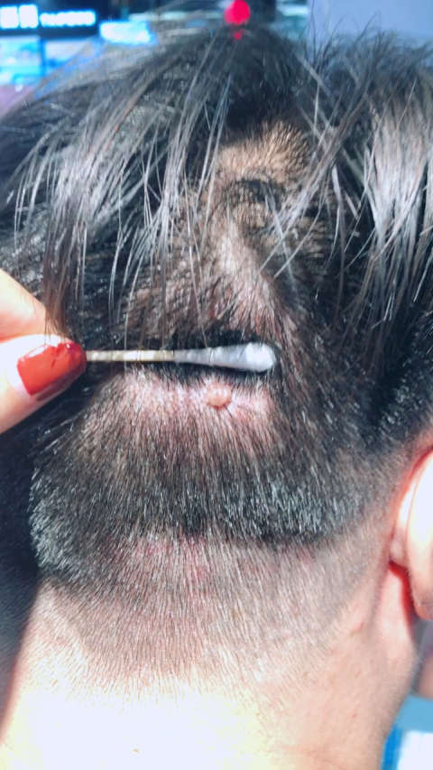 祛除头部大肉痣