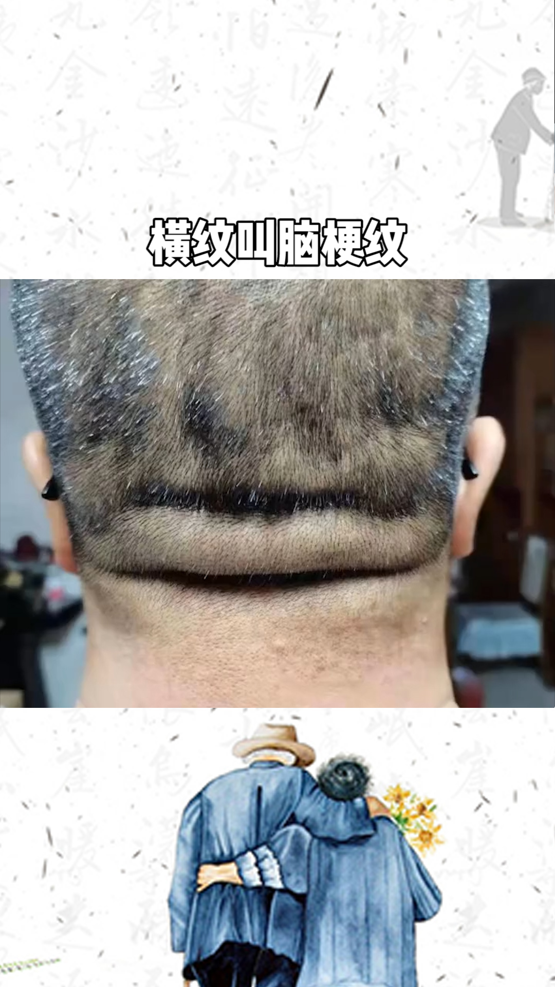 横纹叫脑梗纹 ,竖纹叫脑出血纹,遇到这样的人,别和他喝酒,别和他吵架