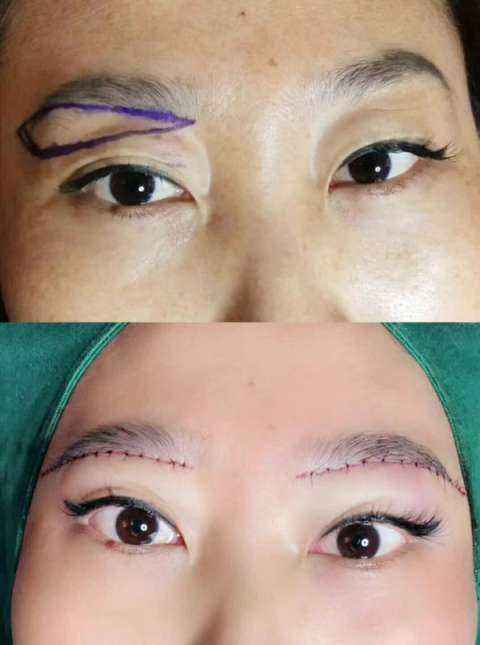 提眉效果对比