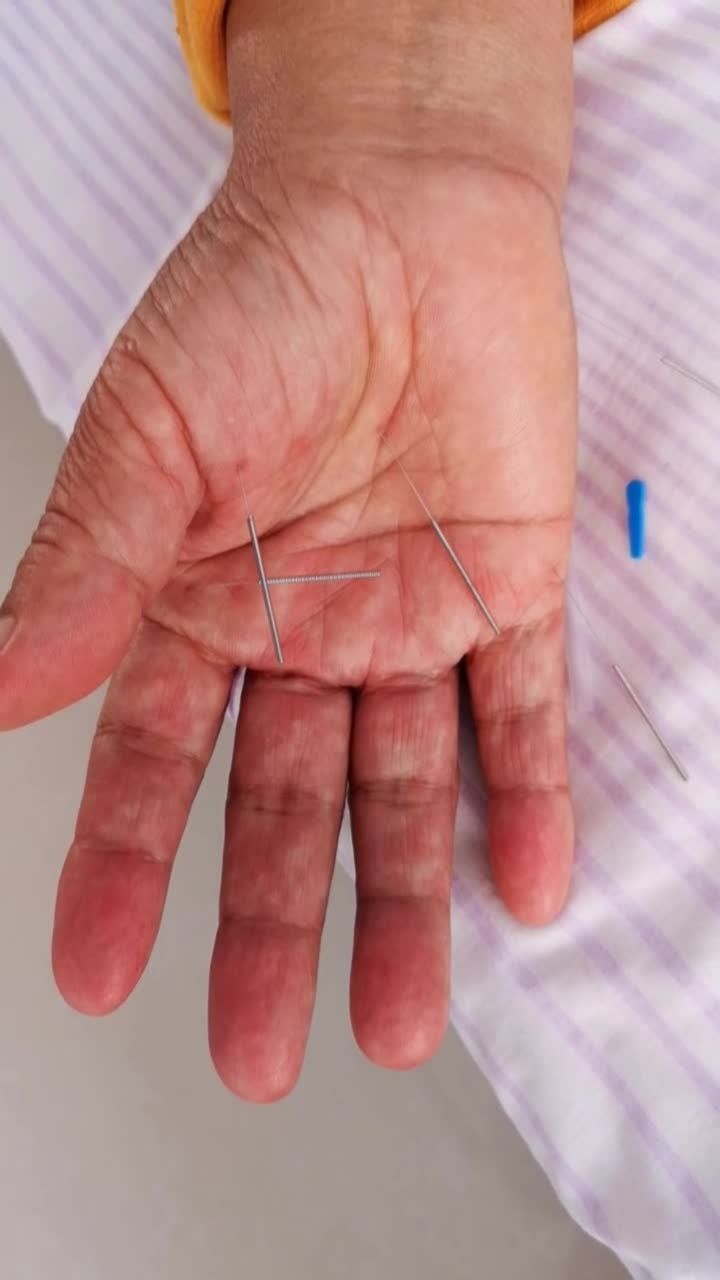 手针,脐针