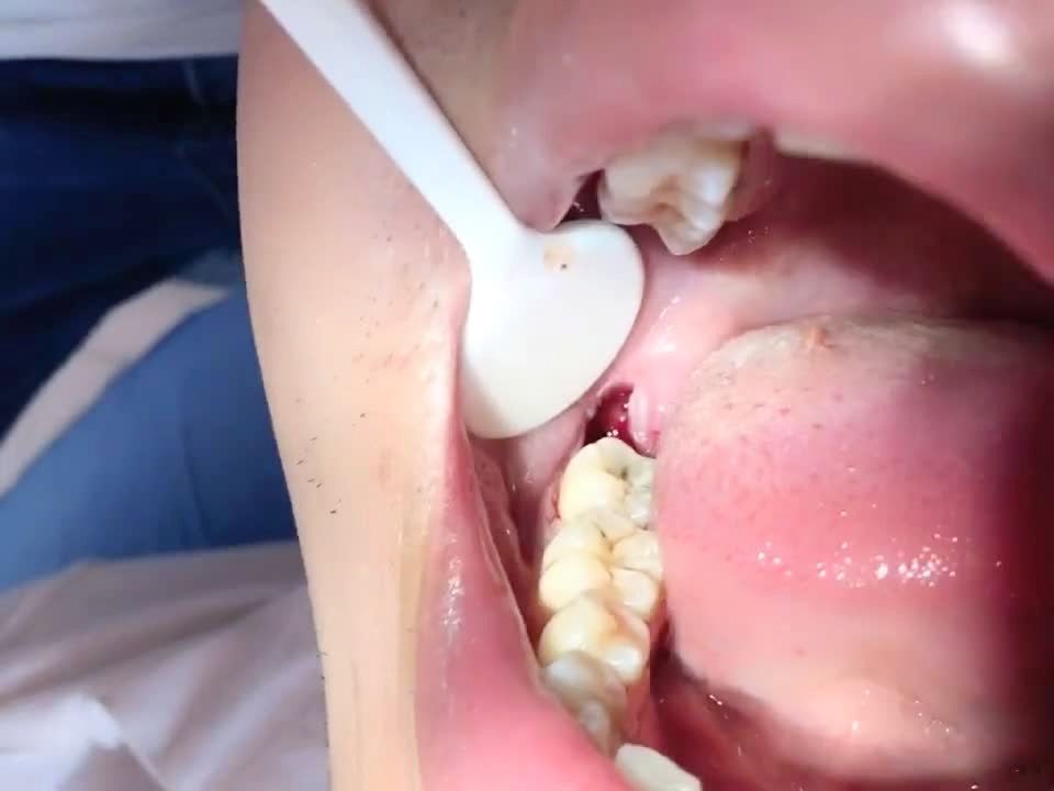 刚刚拔出的智齿