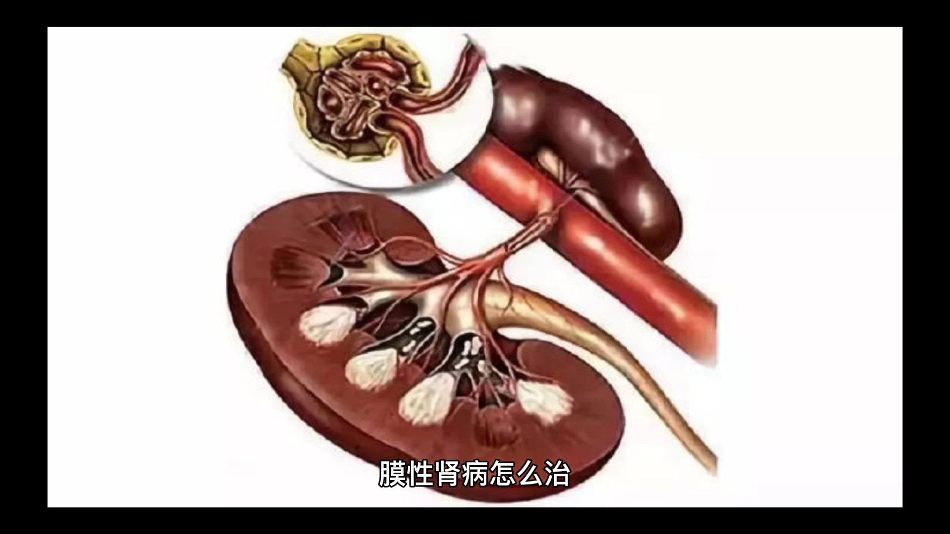 膜性肾病怎么治?