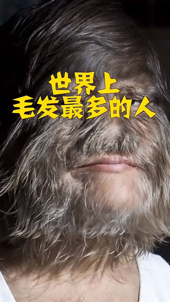 世界毛发最多的人