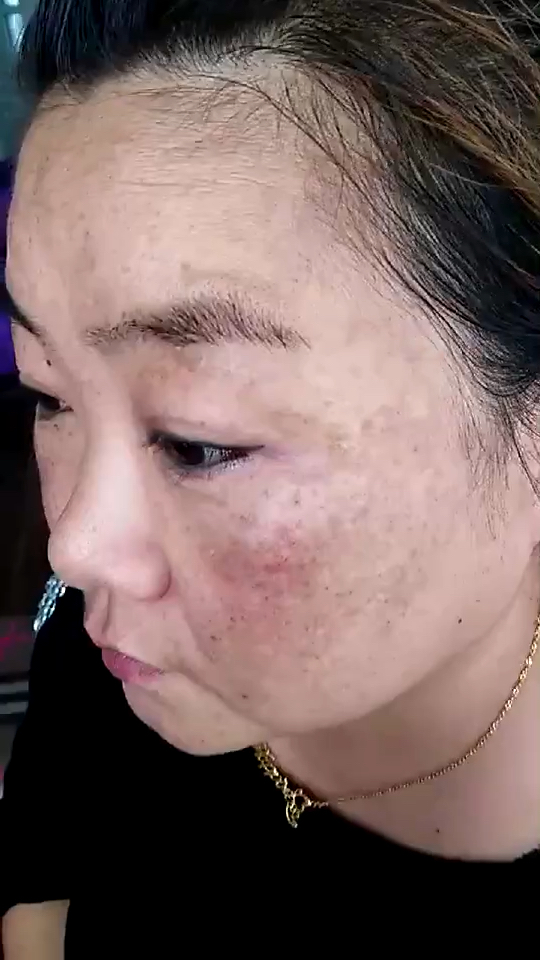 黄褐斑,重度,准备治疗中