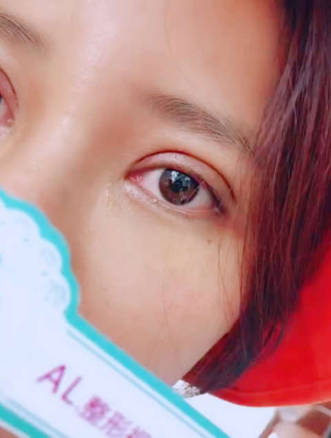 芭比双眼皮第7天