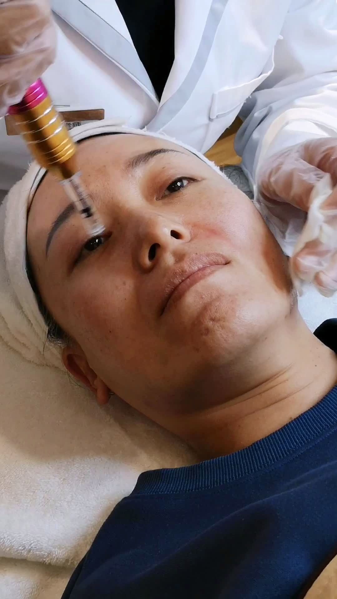 无针微整-法令纹填充,祛眼袋