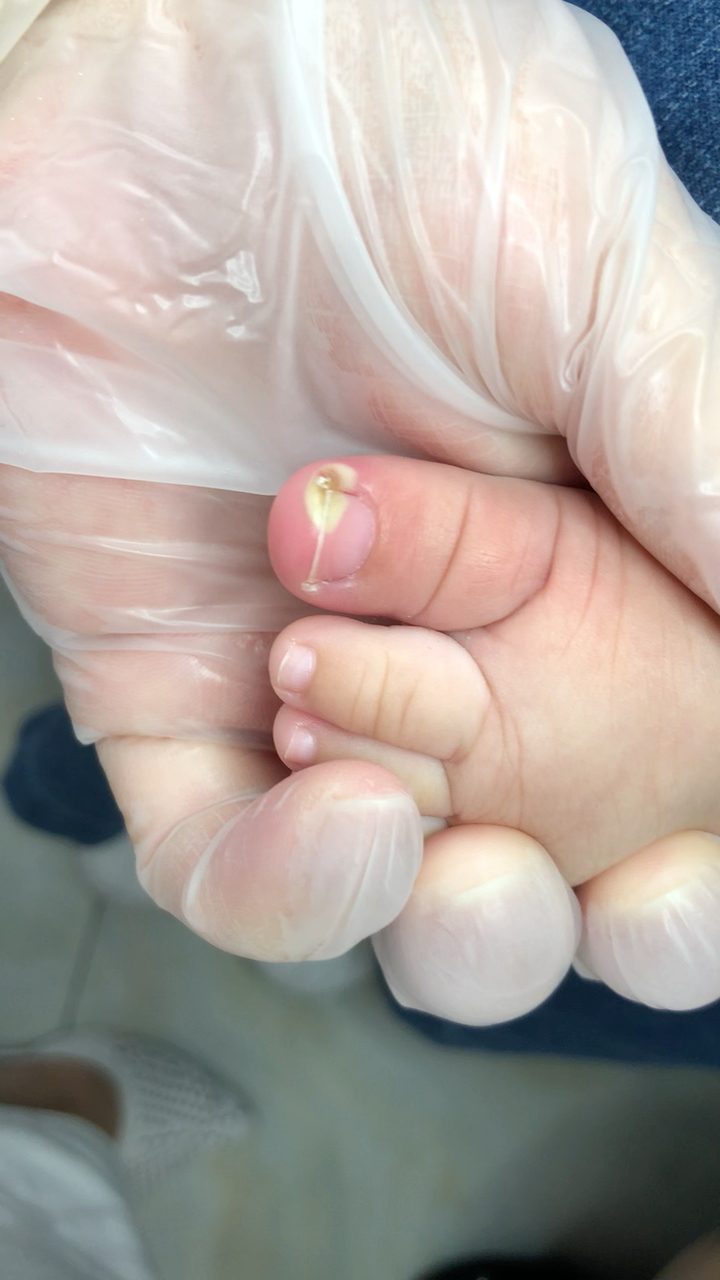 56615个月大的宝宝就有甲沟炎嵌甲,看着挺揪心的.