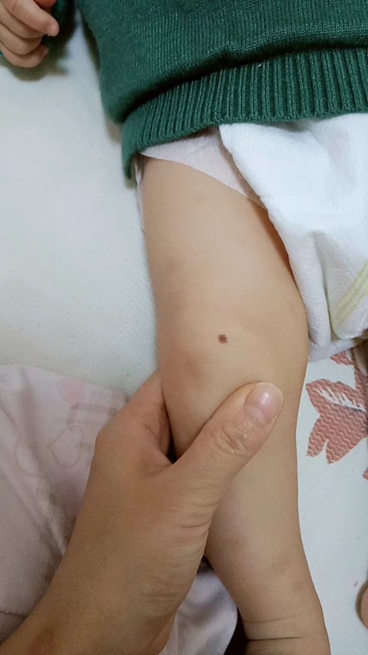 宝宝生下来膝盖上就带了这颗痣!不知道好不好
