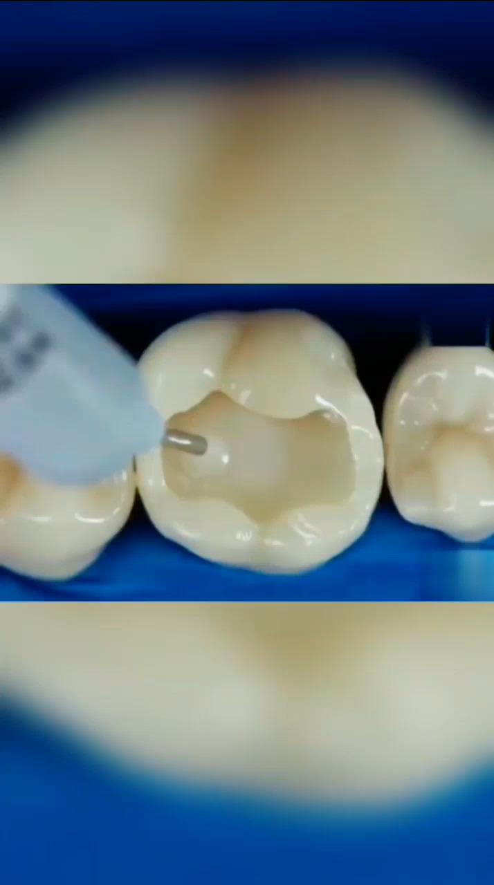 补好的牙跟真牙一模一样,如果不看过程,你能看出哪颗牙是补的吗?