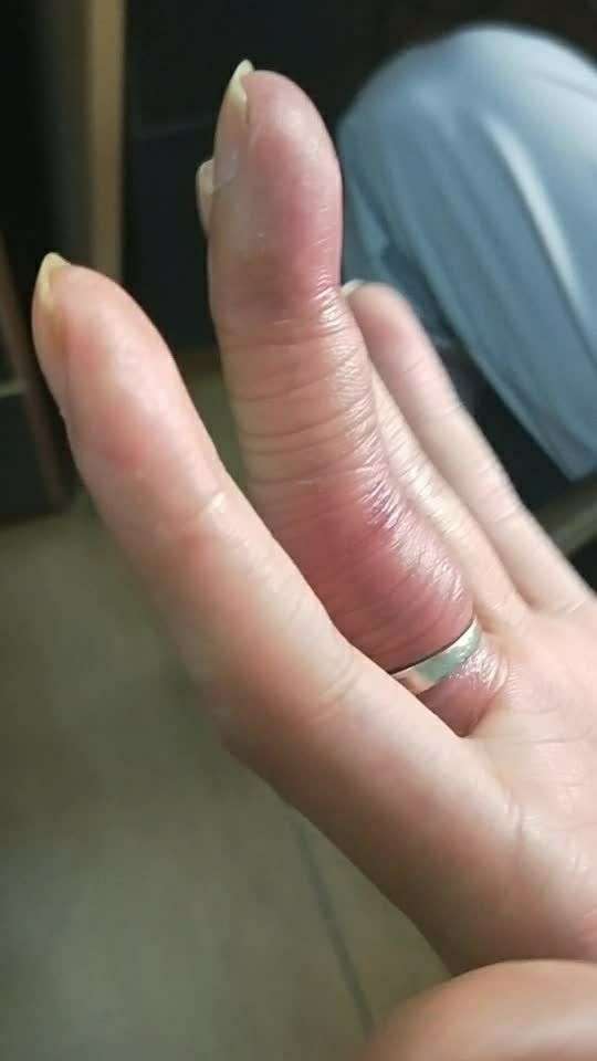 同事手肿成这样,可惜了婚戒,万能的微友们,还有其他办法吗 00