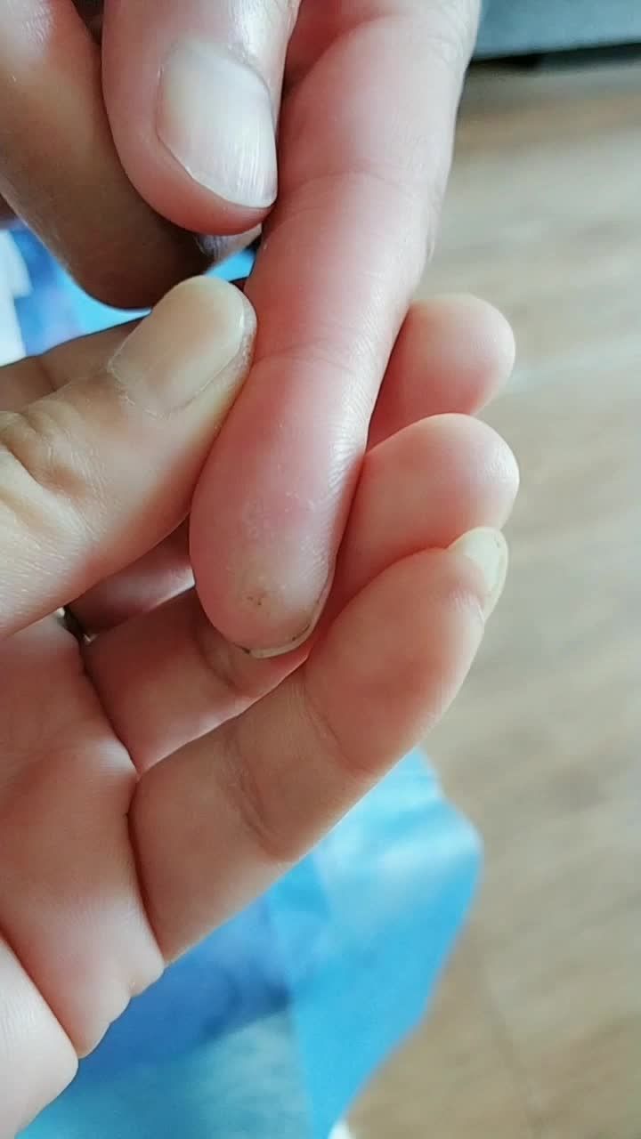 被鱼刺扎过的手