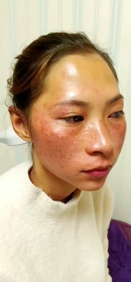 祛斑第一步排色