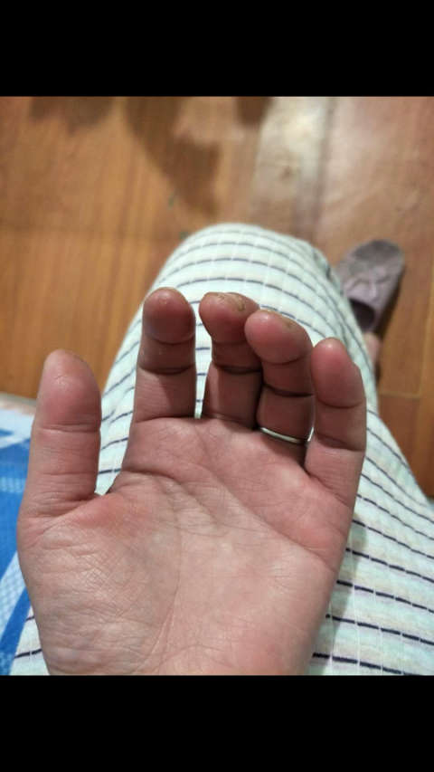 皮肌炎患者手部症状