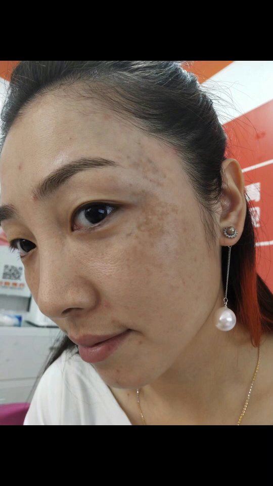 奢女郎客户真皮斑    前后对比照片    祛斑45天让她找回失去的美