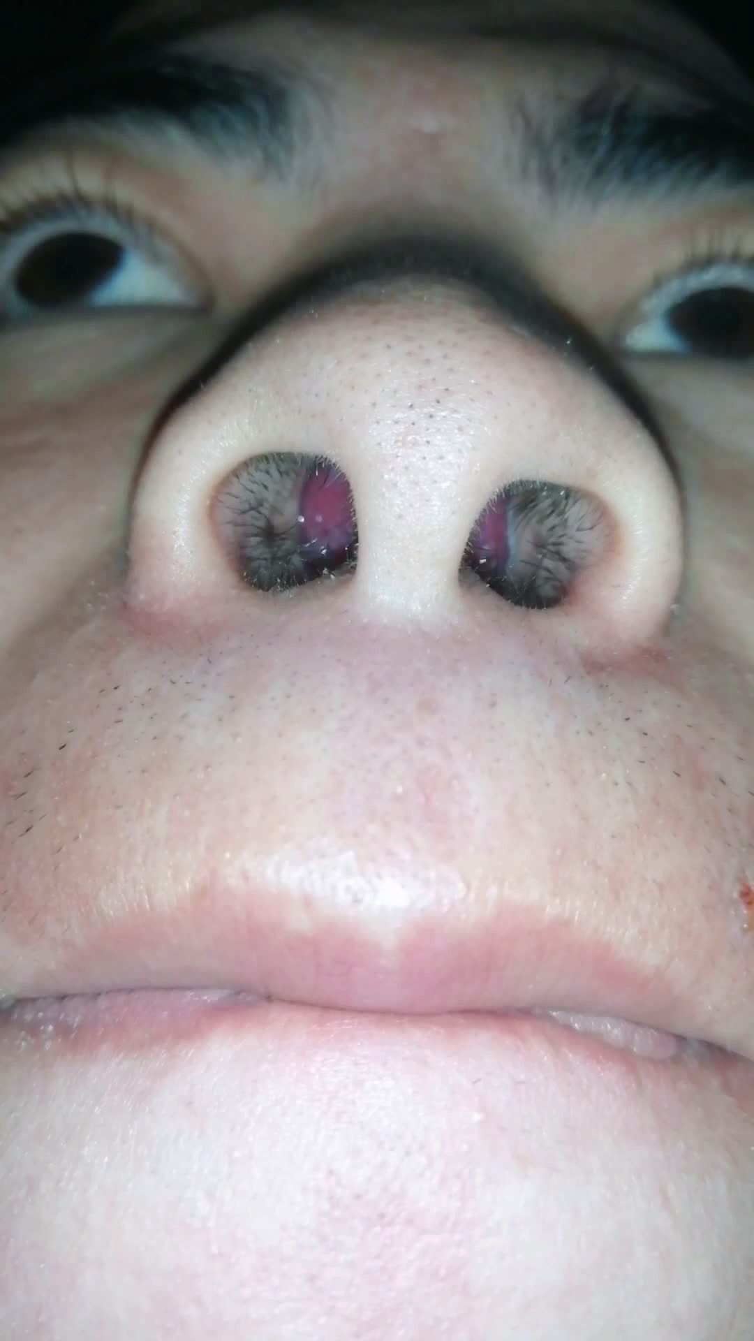 鼻甲肥大,慢性鼻炎患者