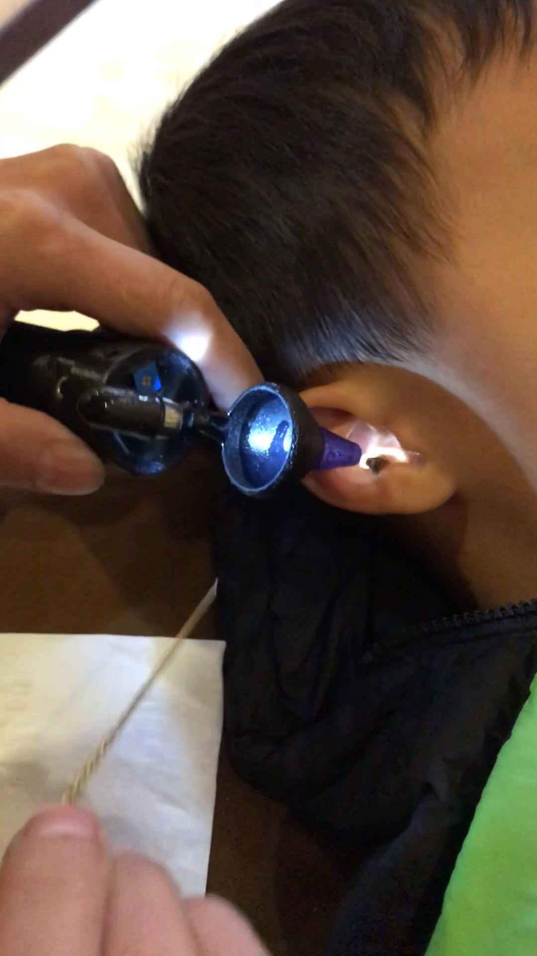 《小孩子取耳结》宜宾最专业的采耳 专业采耳.修脚.洗眼.艾灸.刮痧.