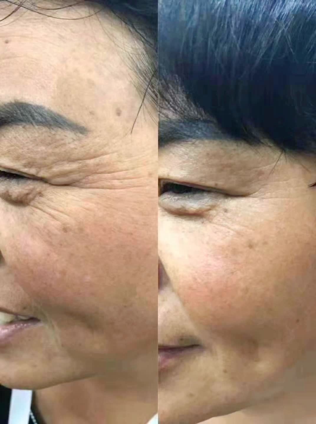 案例51566一次去掉眼角纹73祛皱,只需5分钟!