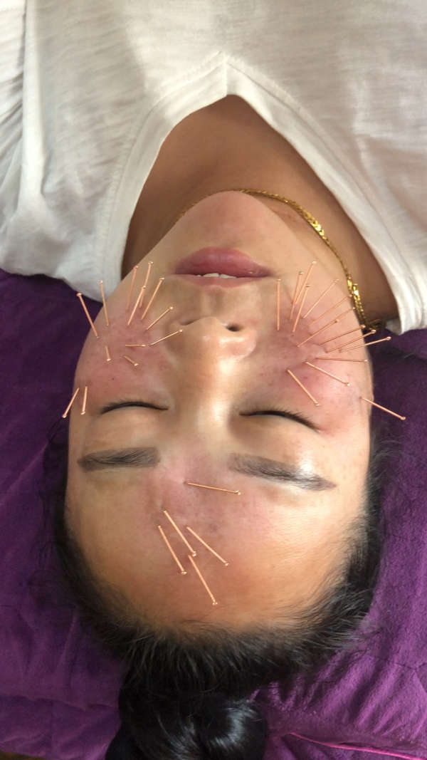 最新祛斑技术,针灸治疗铅汞斑,黄褐斑等顽固斑!