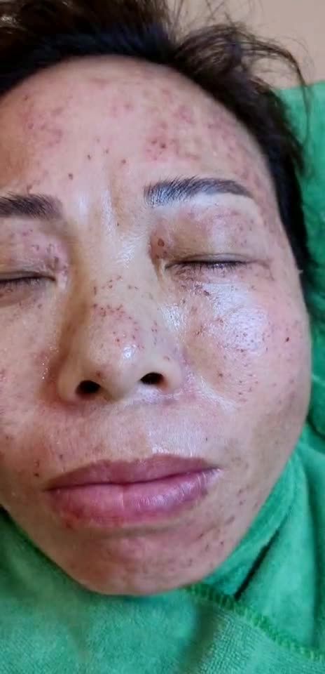 混合斑技术操作!