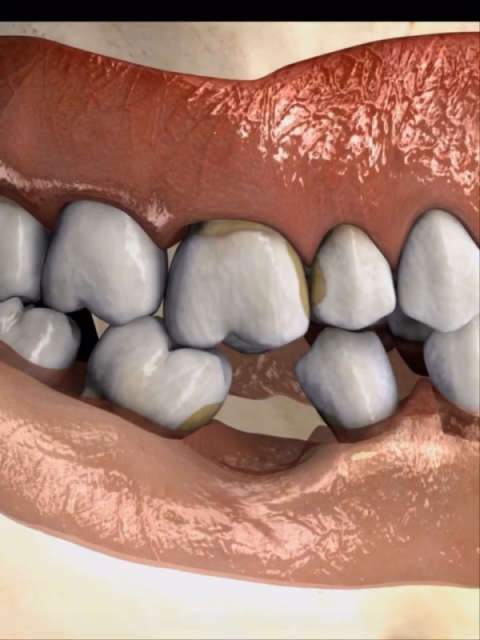 牙床变形图片图片