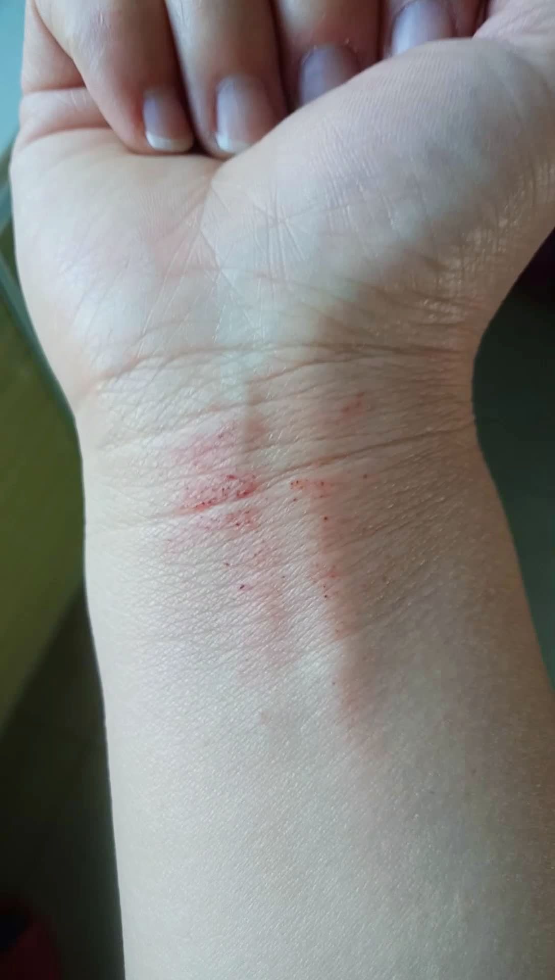 这两天脑子进水了01昨天洗衣服把手腕擦伤,今天又把锅烧干,有跟我