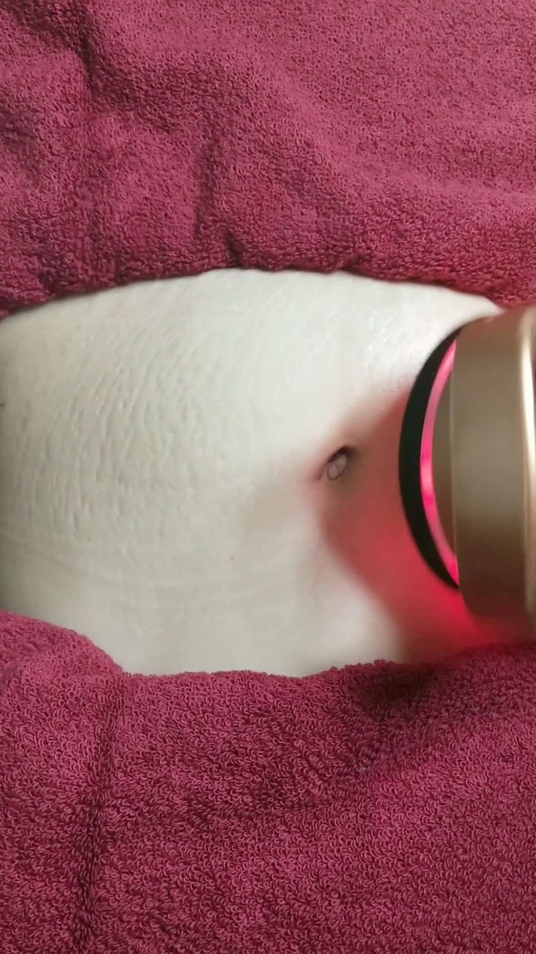 5年的妊娠纹修复中,看一下两侧对比