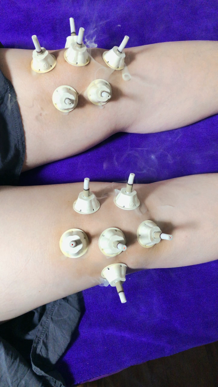 膝盖痛,滑膜炎,骨刺,半月板损伤怎么办;这样艾灸