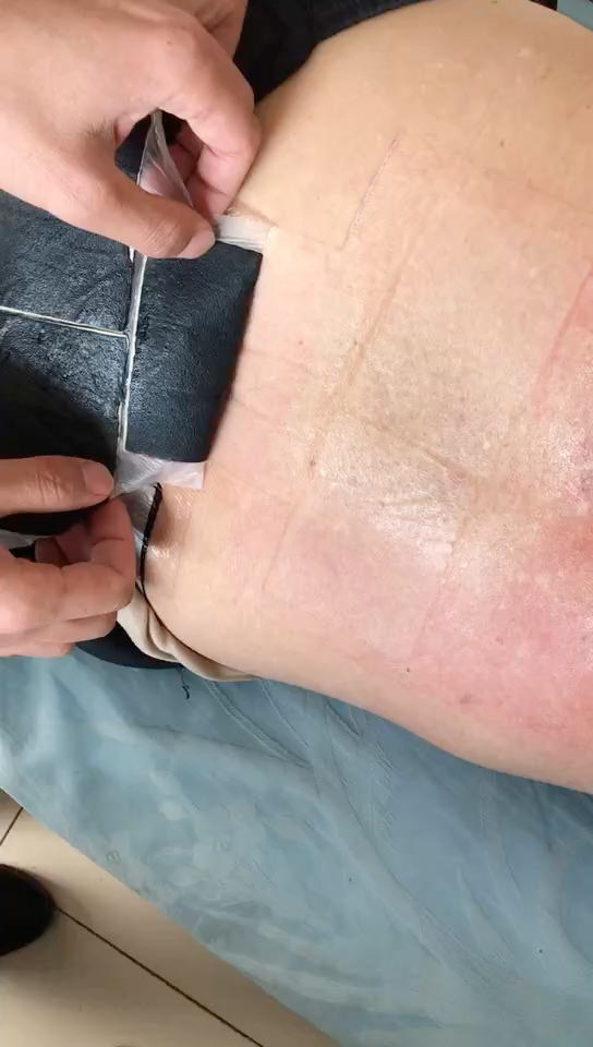 仔细看,整个背同样贴老倪膏药,皮肤不同表现