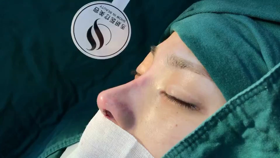 肋骨隆鼻术后即刻