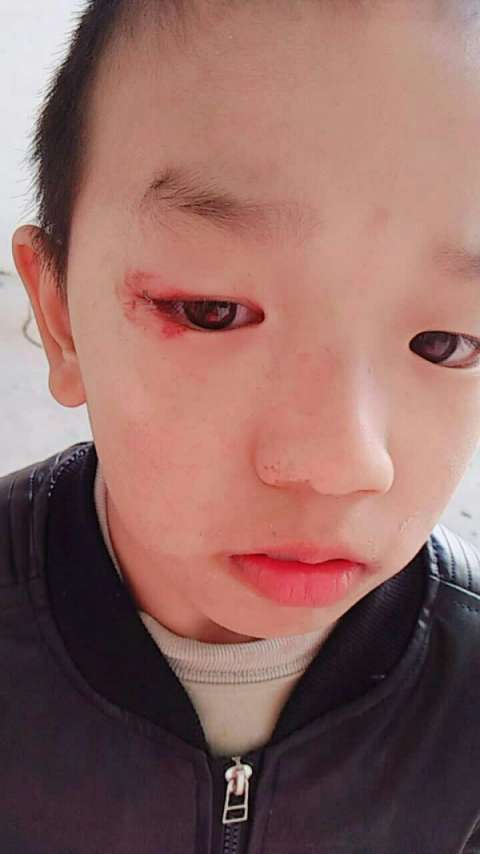 眼睛被人戳了.