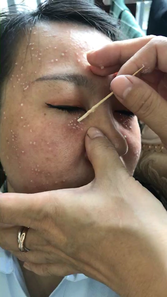 扁平疣 汗管瘤 结痂脱落就好啦7815