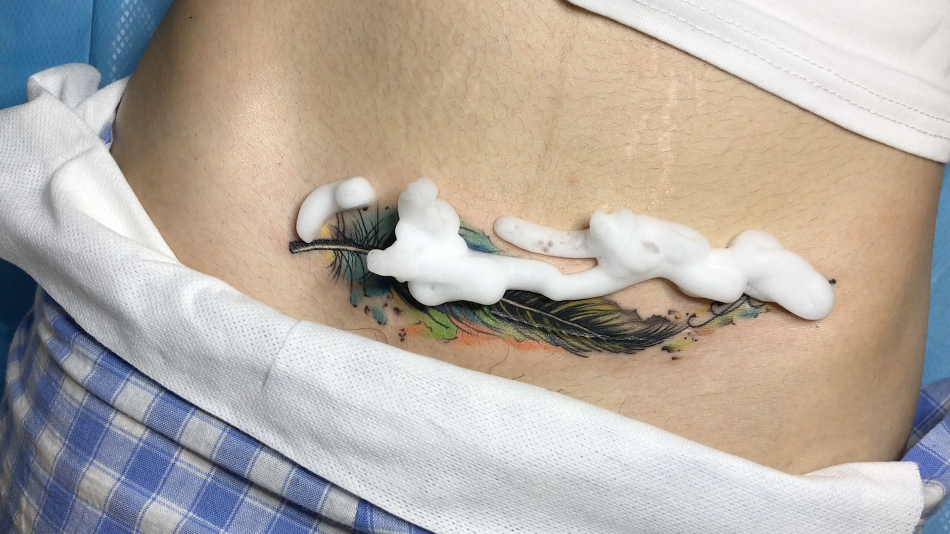 遮盖最美妈妈剖腹产疤痕