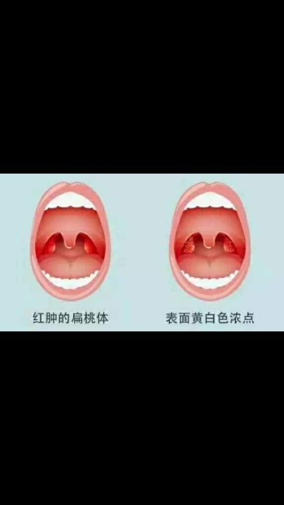 进入秋季后,孩子的扁桃体老是发炎,出现喉咙肿痛,发烧等症状