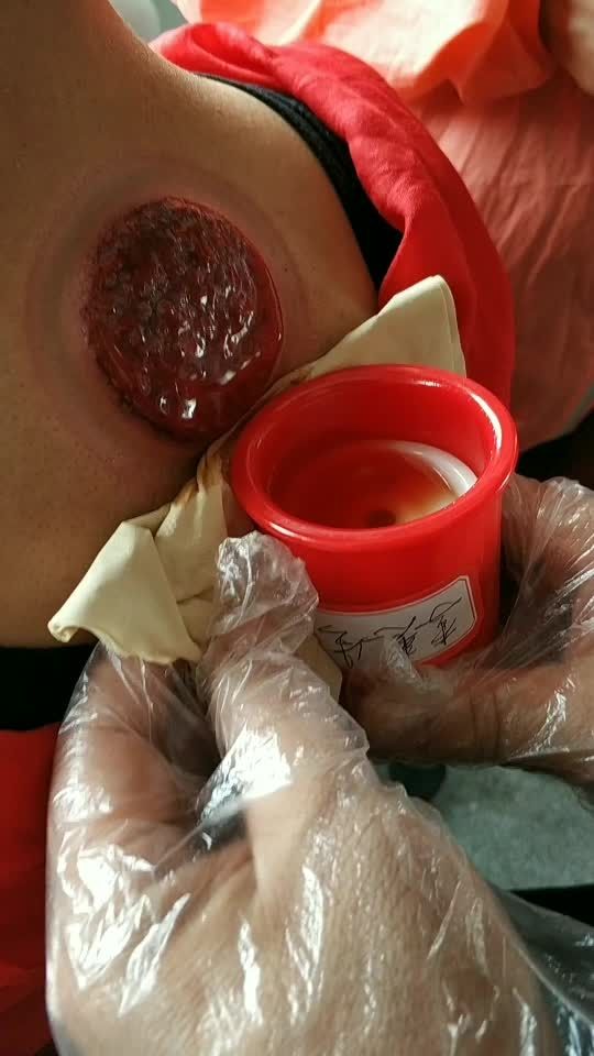 拔罐治疗风湿骨病见过吗