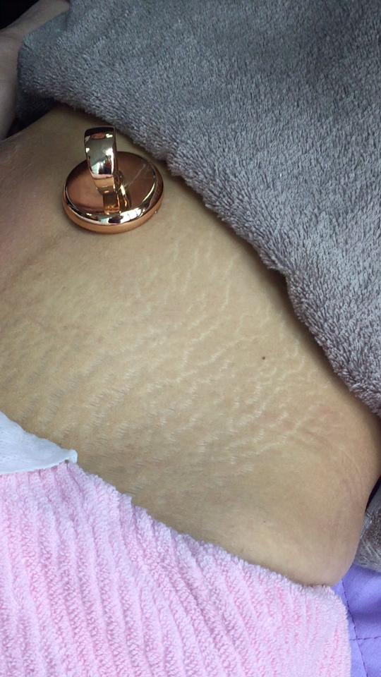 妊娠纹,不见了,花肚皮,不见了,消失了